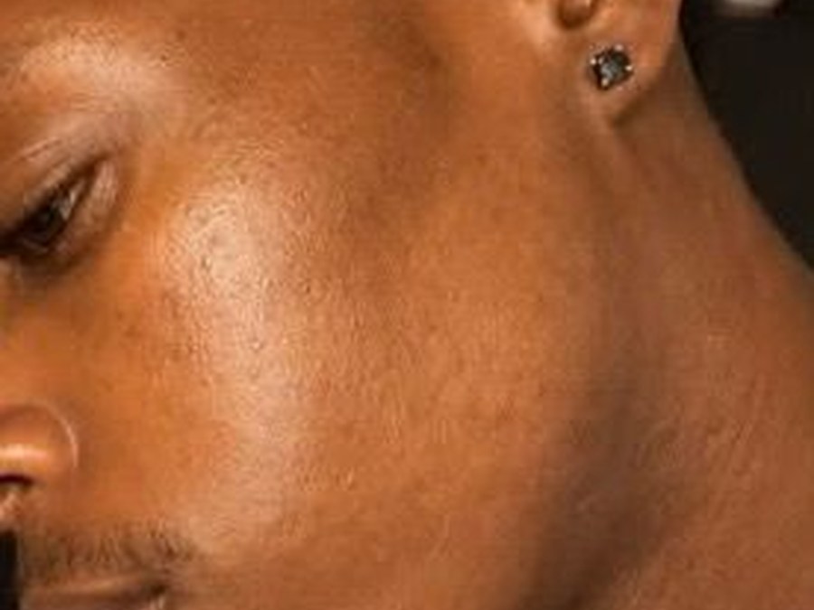 Same client with clear, even skin after a Gifted MO skin journey
