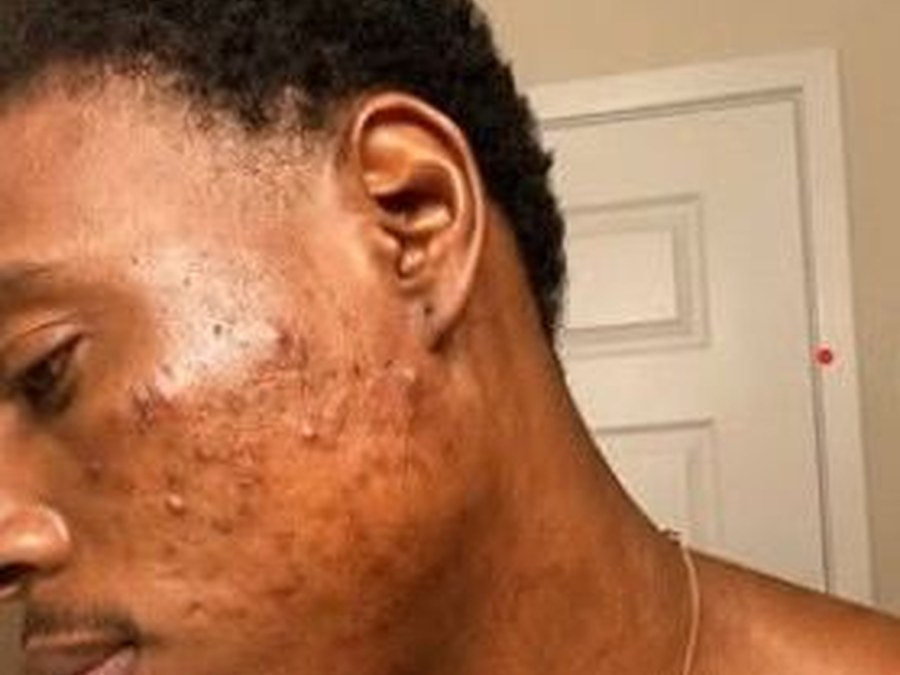 Client acne on cheek and jaw before treatment at Gifted MO