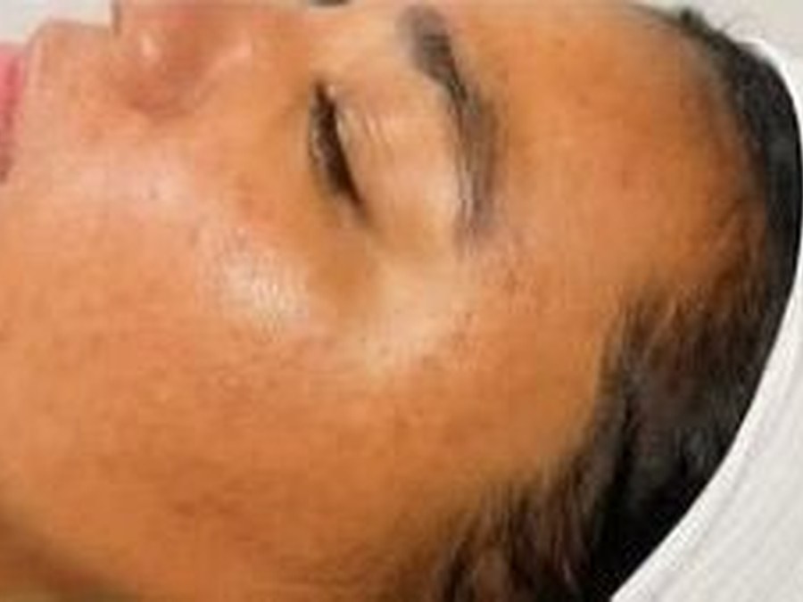 Same client with calm, refined skin after facials at Gifted MO